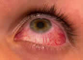 rinite_e_congiuntivite_allergica