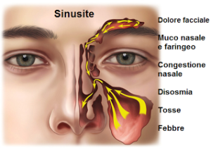 sinusite