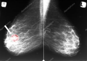 mammografia esame tumore